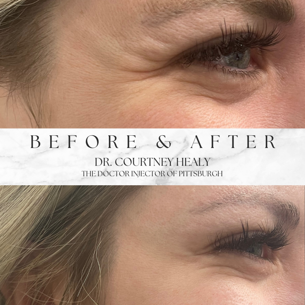 crow's feet before and after with botox at pittsburgh aesthetics