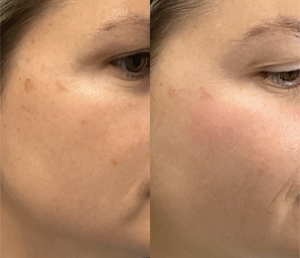 BBL winter treatment result for pigmentation — Cranberry, PA